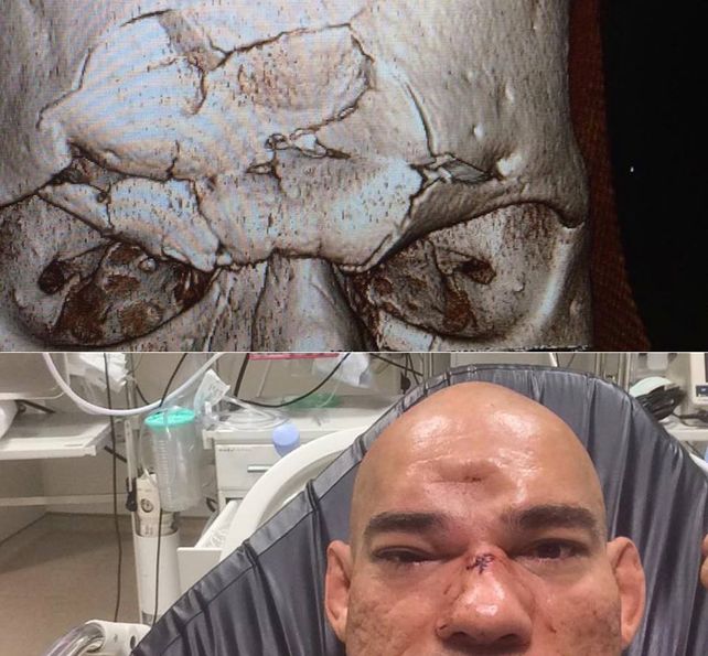 Un luchador sufrió fractura de cráneo y terminó con la frente hundida tras un esperado combate