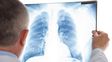 Nódulo pulmonar: qué significa encontrarlo en una tomografía y cuándo puede ser cáncer