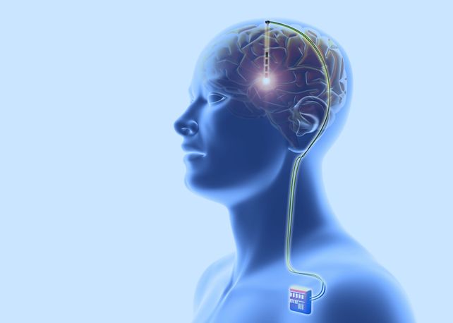 El novedoso dispositivo para Parkinson se aplicó a una mujer adulta que vive en Entre Ríos.