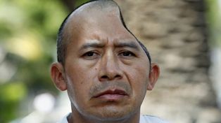 Indemnizan con U$S 58 millones tras dejarlo sin parte de su cabeza