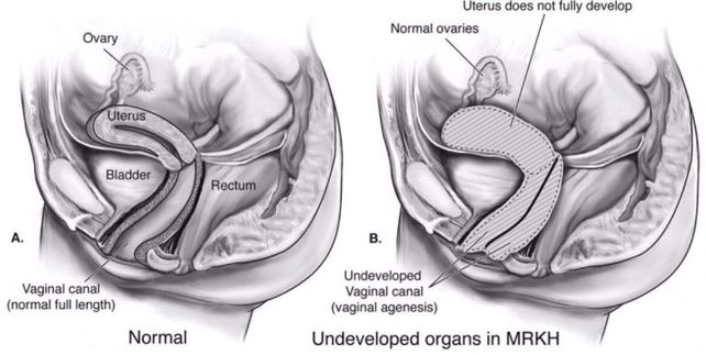 Un caso de estudio: Nació sin vagina, la apuñalaron y quedó embarazada