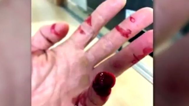 Un policía perdió un dedo por un mordisco durante una detención