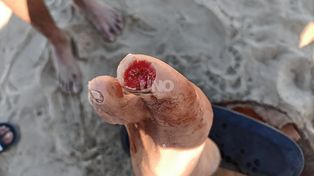 Feroz ataque de palometas a dos bañistas en la ciudad de Coronda.&nbsp;