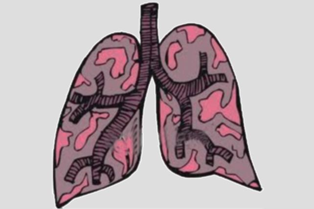 Hoy es el Día Mundial de la Tuberculosis