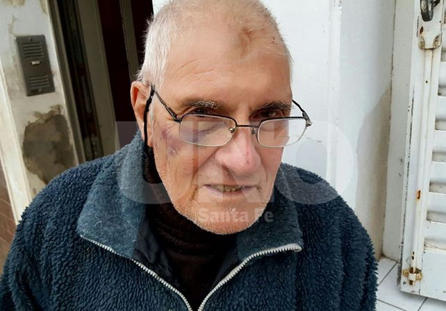 Visible. El hematoma del ojo derecho que sufrió Carlos Surjan Bilac