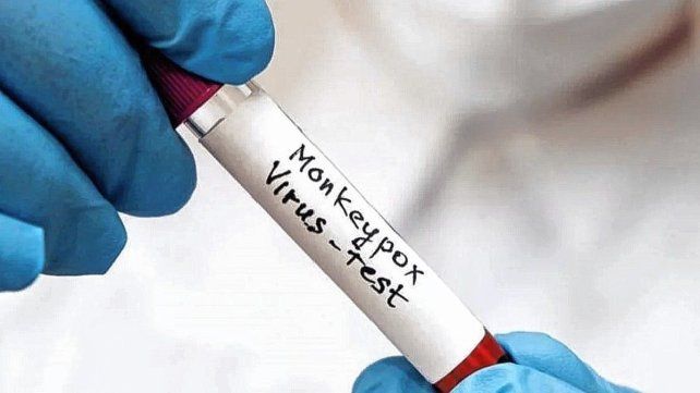El caso de viruela del mono fue confirmado por el Instituto Malbrán.