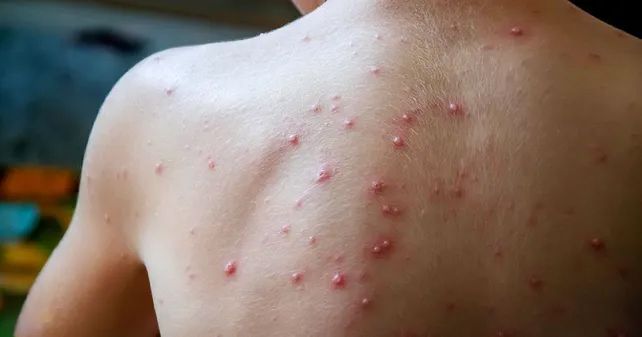 La OMS emitió un alerta por la viruela del mono.