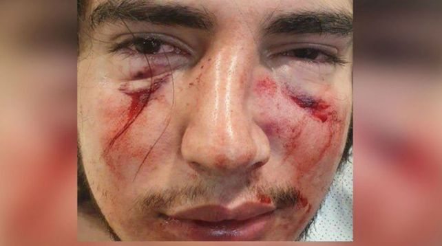Atacado. El joven sufrió fractura de tabique y de órbita ocular