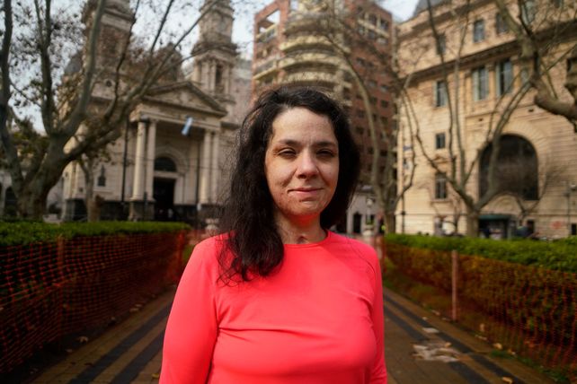 Noelia sigue sufriendo las secuelas de las quemaduras que sufrió tres años atrás