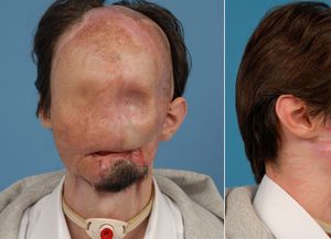 Tras un nuevo transplante, el hombre sin rostro tiene una cara nueva