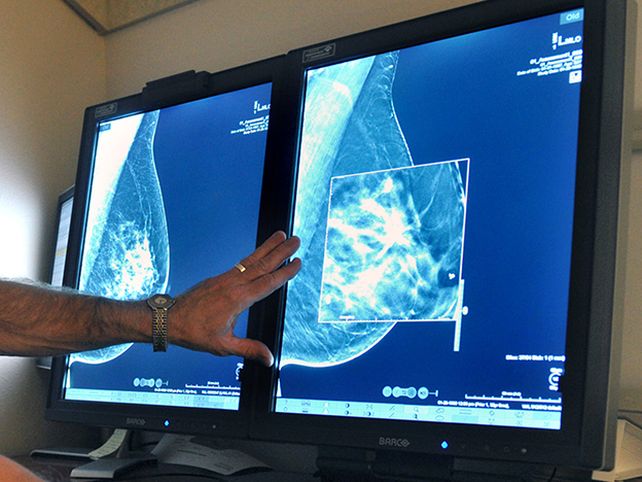 Cáncer de mama: innovadora terapia para combatir tumores luminal