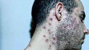 Según la OMS, la viruela del mono ya no es emergencia sanitaria