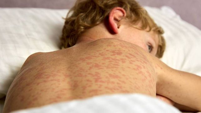 El brote de sarampión en Buenos Aires encendió las alarmas locales