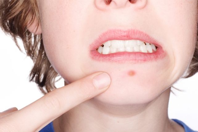 ¡No te brotes! Los 6 alimentos que no debés comer si tenés acné