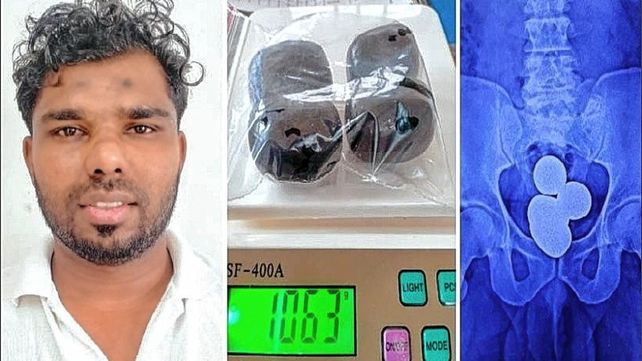 Llevaba más de un kilo de oro en el recto y terminó preso