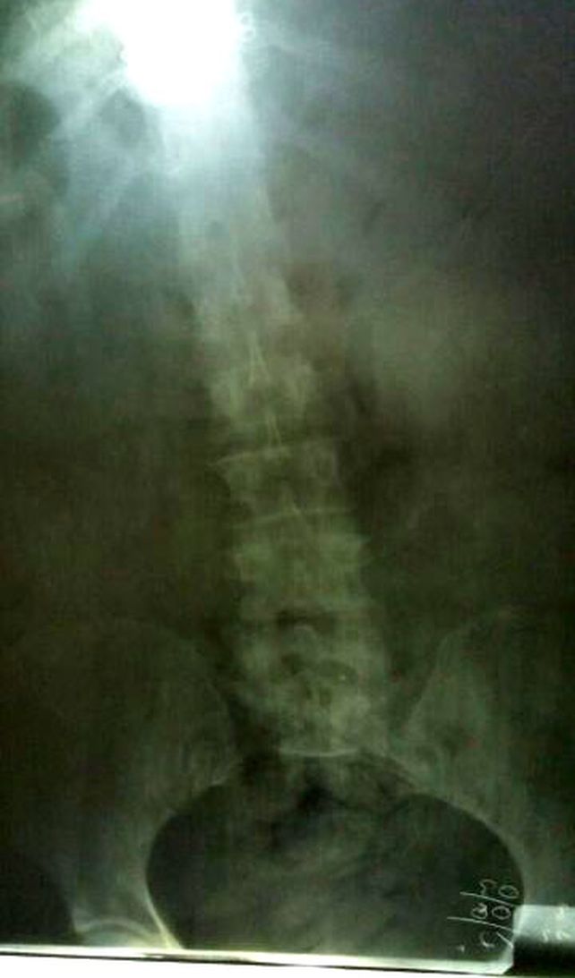 La radiografía que muestra la ingesta&nbsp;