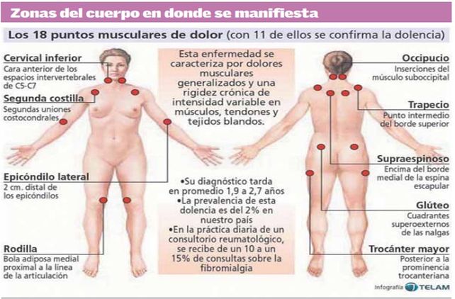 Fibromialgia: sus síntomas y los tratamientos actuales