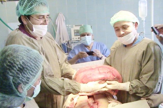 Increíble: le extraen un tumor de 15 kilos a una mujer en estado de embarazo
