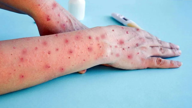 Se registraron 14 casos de este virus en América en lo que va del año&nbsp;