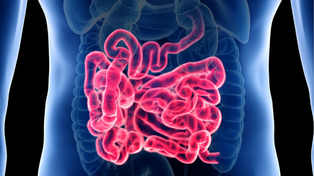 Enfermedad intestinal inflamatoria ¿De qué se trata?