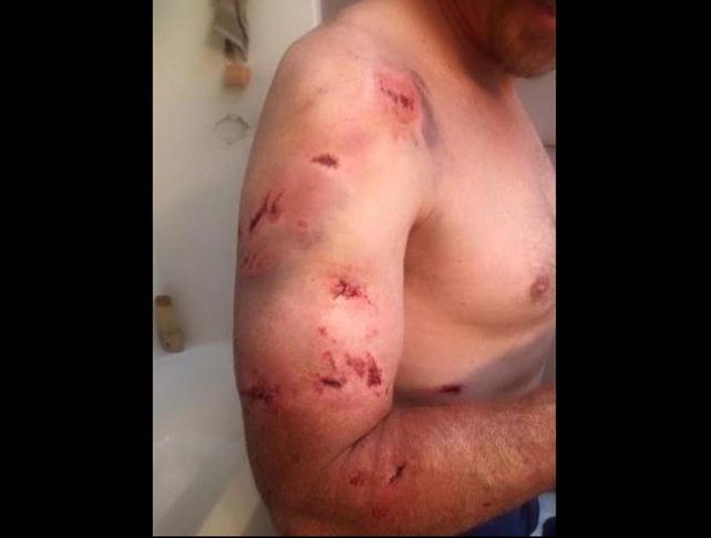Así quedó un cazador tras ser atacado  por un oso