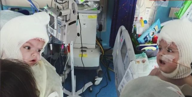 El estremecedor momento en el que dos siameses se miran a los ojos tras ser separados