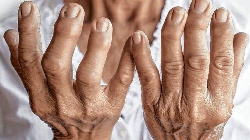 Enfermedades reumáticas: poder reconocer los síntomas ayuda a acceder a un diagnóstico precoz