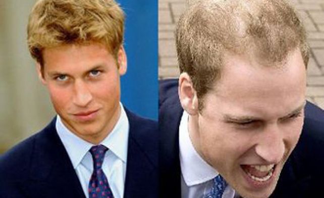 El pr&iacute;ncipe William preocupa a la corona brit&aacute;nica por su avanzada calvicie