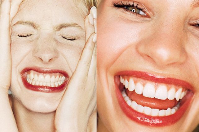 ¿Qué es la gingivitis?