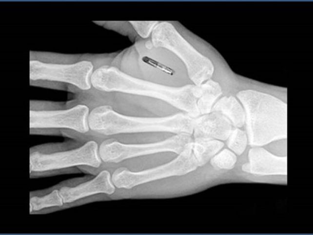 Chips en el cuerpo, lo nuevo en tecnología