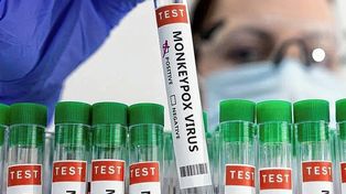 Viruela del mono: se confirmó el primer caso en Argentina