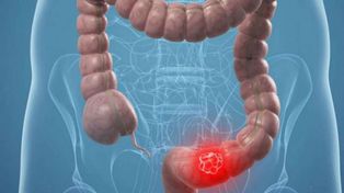 Detectan altísima tasa de cáncer de colon por falta de un control temprano
