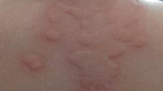 Así quedó la piel del niño agredido con hormigas.