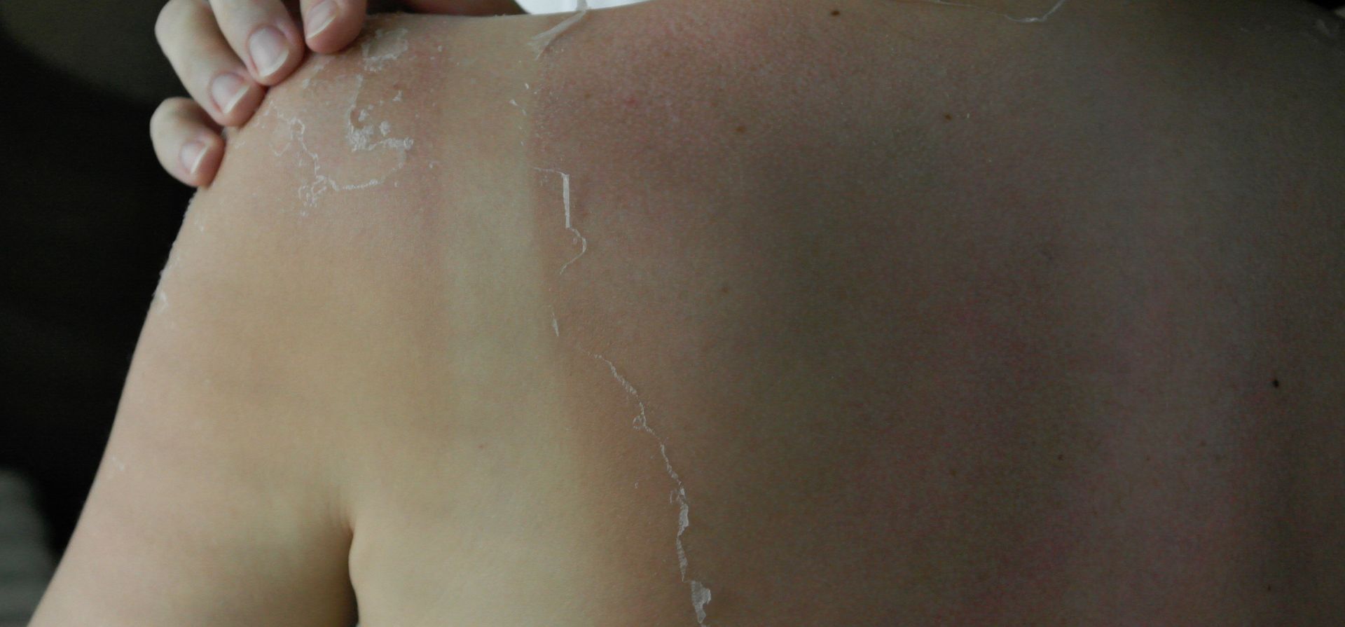 Los cuidados especiales en verano para quienes hacen tratamientos oncológicos