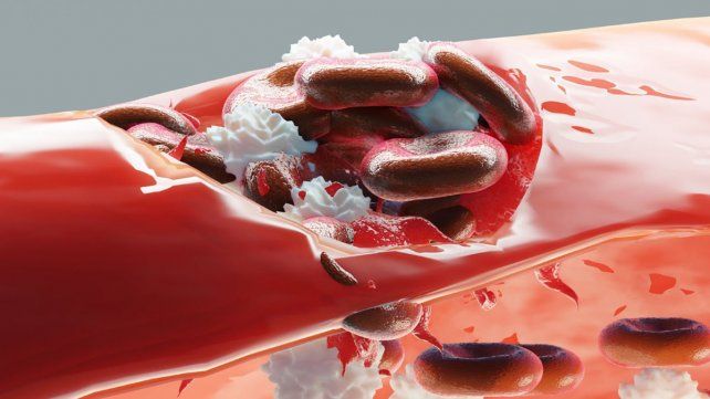 Se recuerda este lunes el Día Mundial de la Hemofilia. Se estima que en el mundo se presenta un caso de hemofilia por cada 10.000 nacimientos.