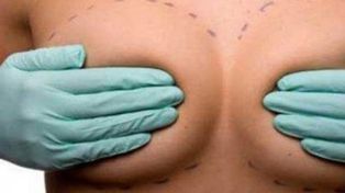 Argentinas querellan por implantes mamarios