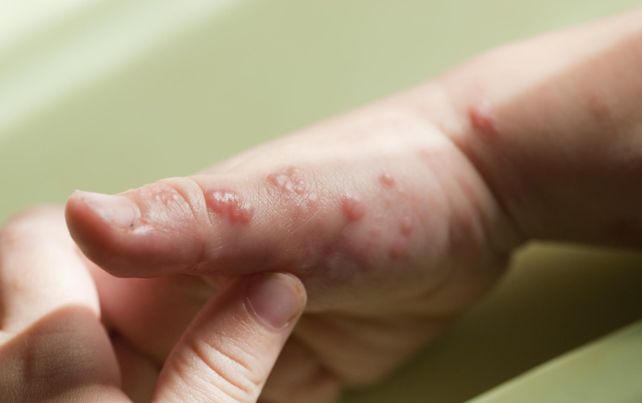 Argentina registra 13 casos de viruela símica o viruela del mono confirmados hasta el 14 de julio