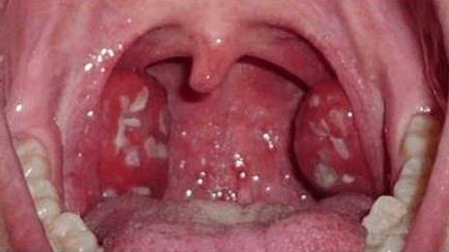 El ministerio de Salud de la Nación notificó 118 casos de infección invasiva por streptococcus pyogenes en el país y 16 fallecidos. Qué es y cómo se contagia&nbsp;