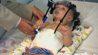 Lograron unir la cabeza al cuerpo de un bebe que sufrió decapitación interna