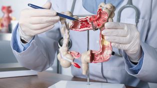 Cáncer de colon: cómo se detecta