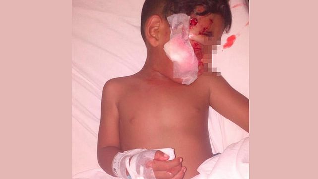 Un perro mordió a un niño en el rostro y la mano