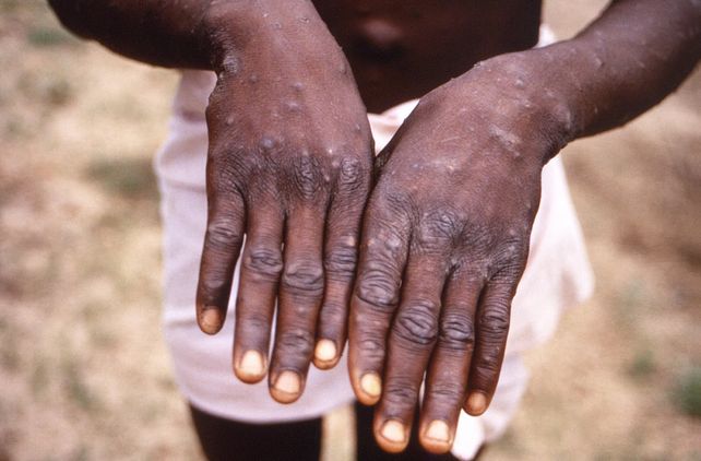 La OMS declara alerta mundial por el brote de mpox en Africa