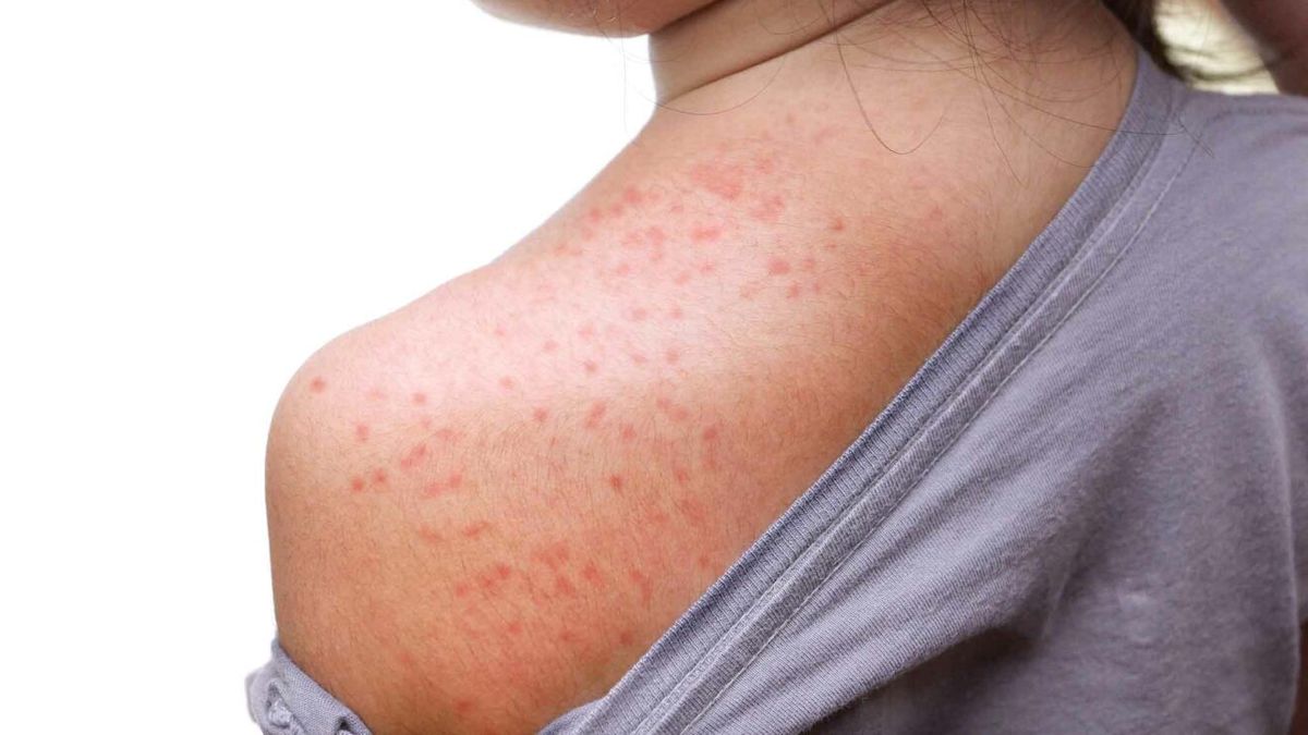 Urgent Call to Vaccinate Children Against Measles in Santa Fe and Rosario – Health Authorities Warn of Rising Cases