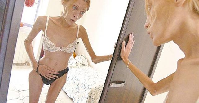 Medidas similares contra la anorexia no lograron aprobarse en la legislatura gala en 2008.