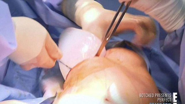 La insólita nueva cirugía del Ken humano: se puso... alas