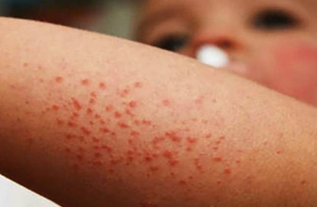 Controlan a todas las personas que tuvieron contacto con el bebé que contrajo sarampión