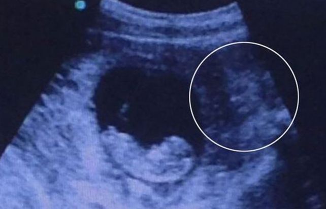 Una ecografía se viralizó ante la supuesta aparición de un demonio mirando a un bebé