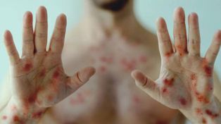 Rosario monitorea la viruela del mono, pero aseguran que no hay mayor alerta sanitaria