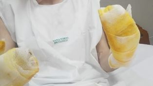 Alexis Leguizamón sufrió heridas de segundo grado en las manos. Su evolución será muy lenta y habrá que ver si sufrirá alguna secuela.&nbsp;