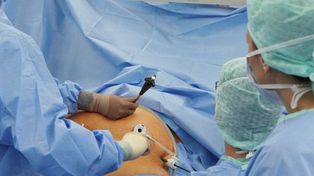La cirugía contra la obesidad mejora la diabetes en un 65 por ciento de los casos